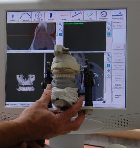 Zahnarzt München: Computer navigierte Implantate mit Robodent